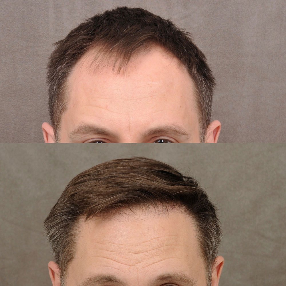 FUE-hair-transplant-3.jpg FUE-hair-transplant-3.jpg